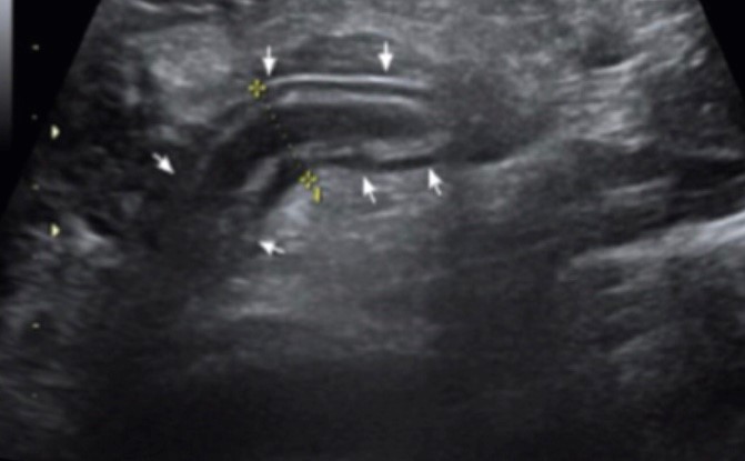 UZV upaljenog crvuljka